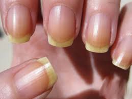 Причини пожовтіння нігтів. Як ефективно відбілити нігті