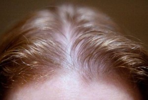 Лікування рідкого волосся