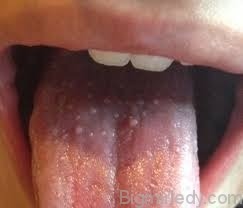 Стоматит на язику у дорослих - причини і лікування