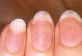 Білі плями на нігтях. Причини появи і лікування вдома