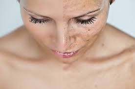 Пігментація шкіри обличчя - причини появи, лікування